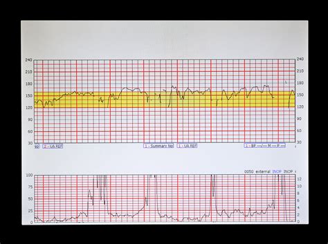 fetal monitoring game|fetal heart rate tracing game.